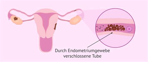 endometriose wie viele frauen